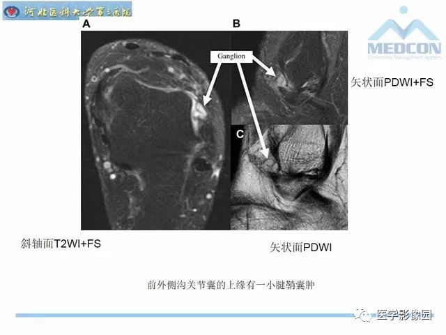 一文详解：踝关节撞击综合征影像诊断