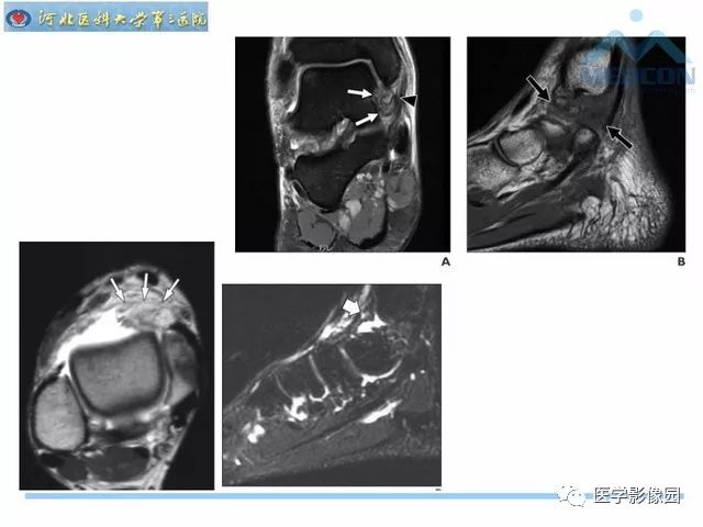 一文详解：踝关节撞击综合征影像诊断