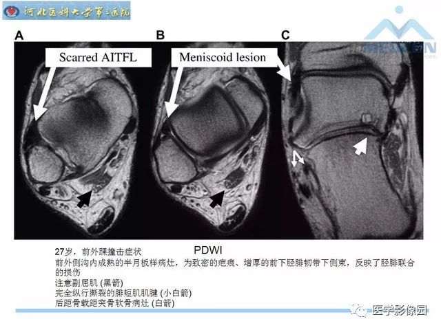 一文详解：踝关节撞击综合征影像诊断