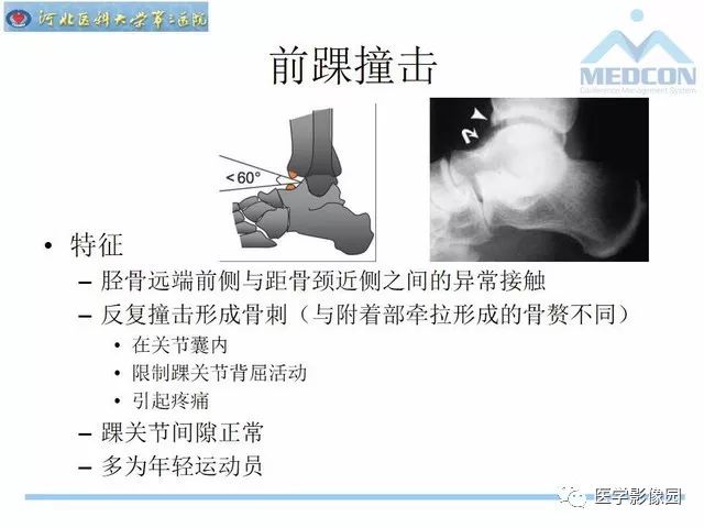 一文详解：踝关节撞击综合征影像诊断