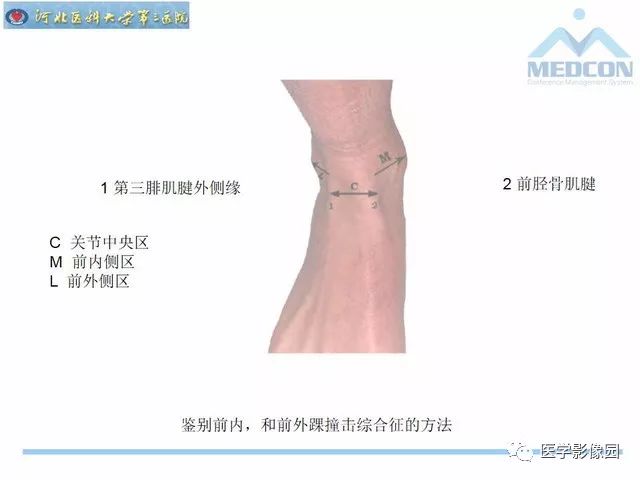 一文详解：踝关节撞击综合征影像诊断