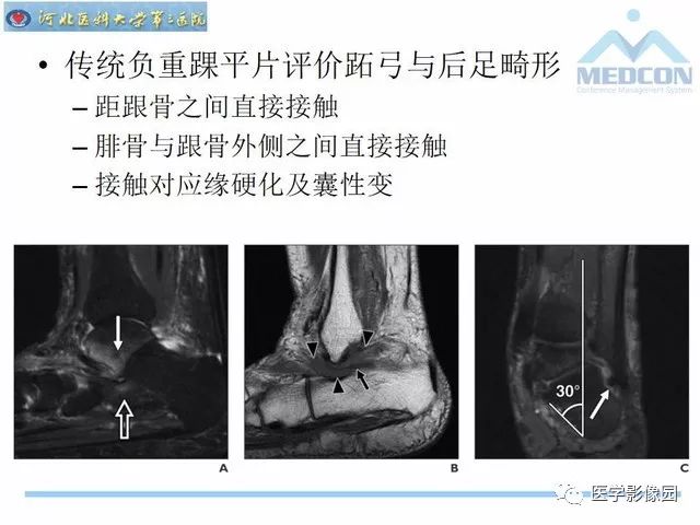 一文详解：踝关节撞击综合征影像诊断