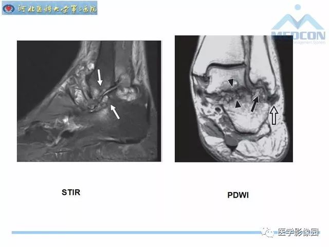 一文详解：踝关节撞击综合征影像诊断