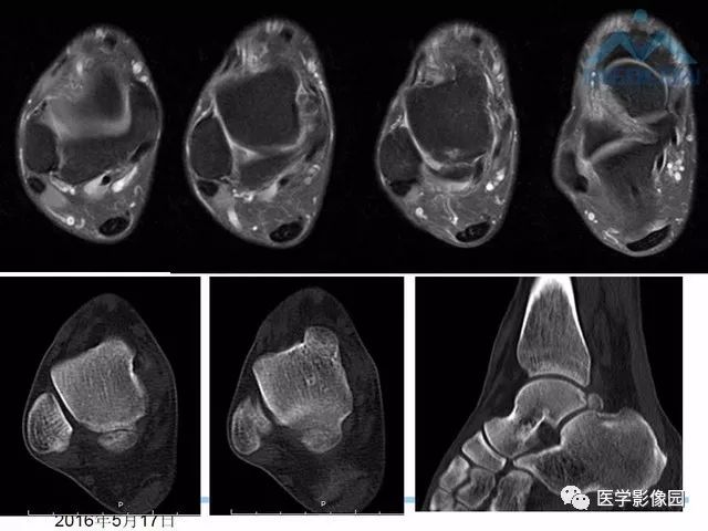 一文详解：踝关节撞击综合征影像诊断