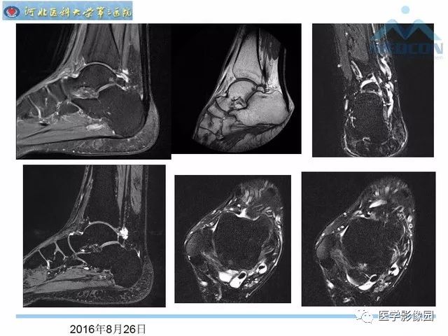 一文详解：踝关节撞击综合征影像诊断