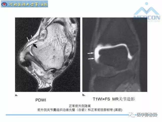 一文详解：踝关节撞击综合征影像诊断