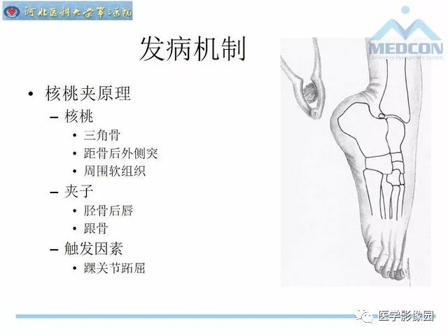 一文详解：踝关节撞击综合征影像诊断