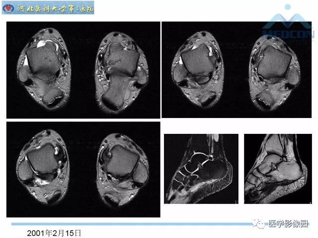 一文详解：踝关节撞击综合征影像诊断