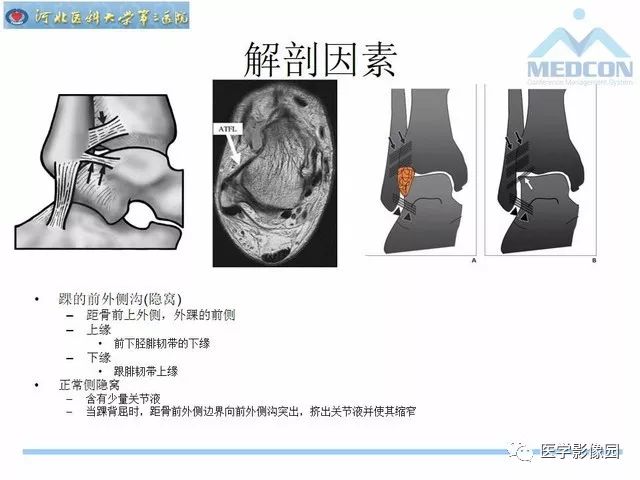 一文详解：踝关节撞击综合征影像诊断