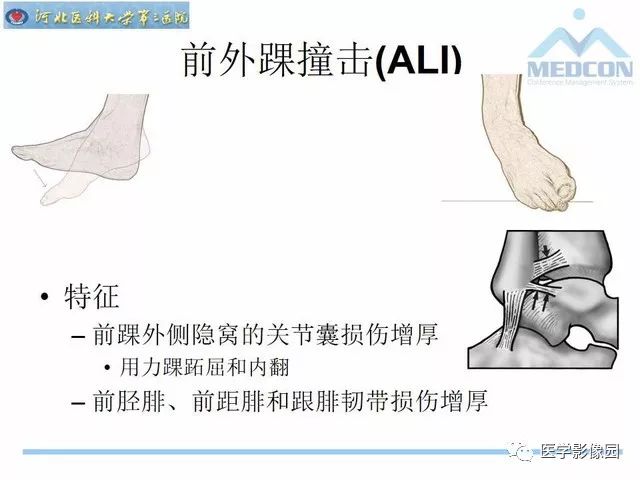 一文详解：踝关节撞击综合征影像诊断