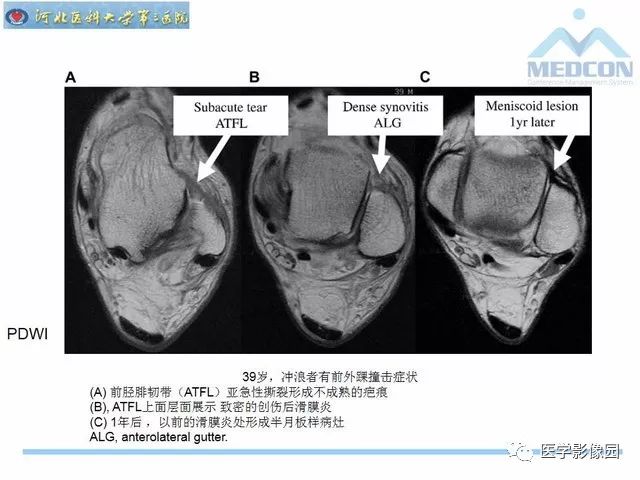 一文详解：踝关节撞击综合征影像诊断