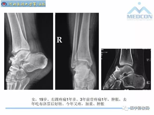 一文详解：踝关节撞击综合征影像诊断