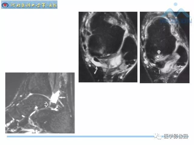一文详解：踝关节撞击综合征影像诊断
