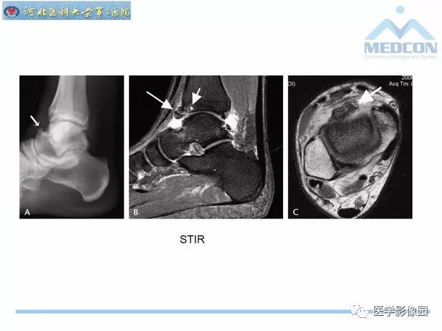 一文详解：踝关节撞击综合征影像诊断
