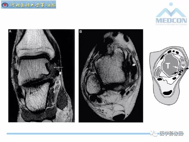 一文详解：踝关节撞击综合征影像诊断