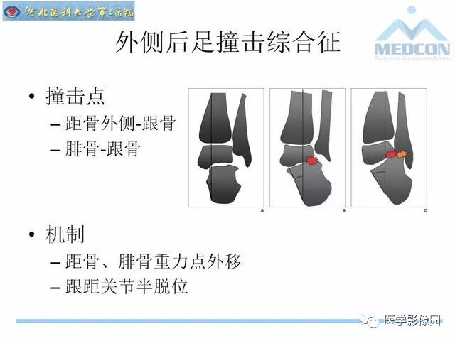 一文详解：踝关节撞击综合征影像诊断