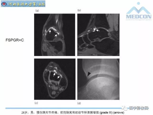 一文详解：踝关节撞击综合征影像诊断