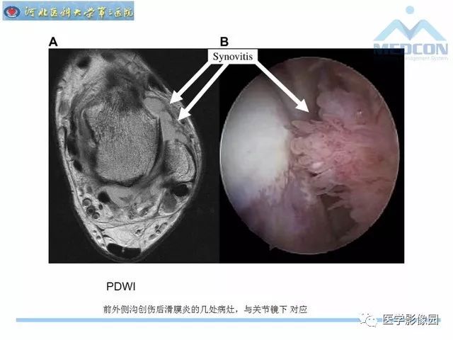 一文详解：踝关节撞击综合征影像诊断