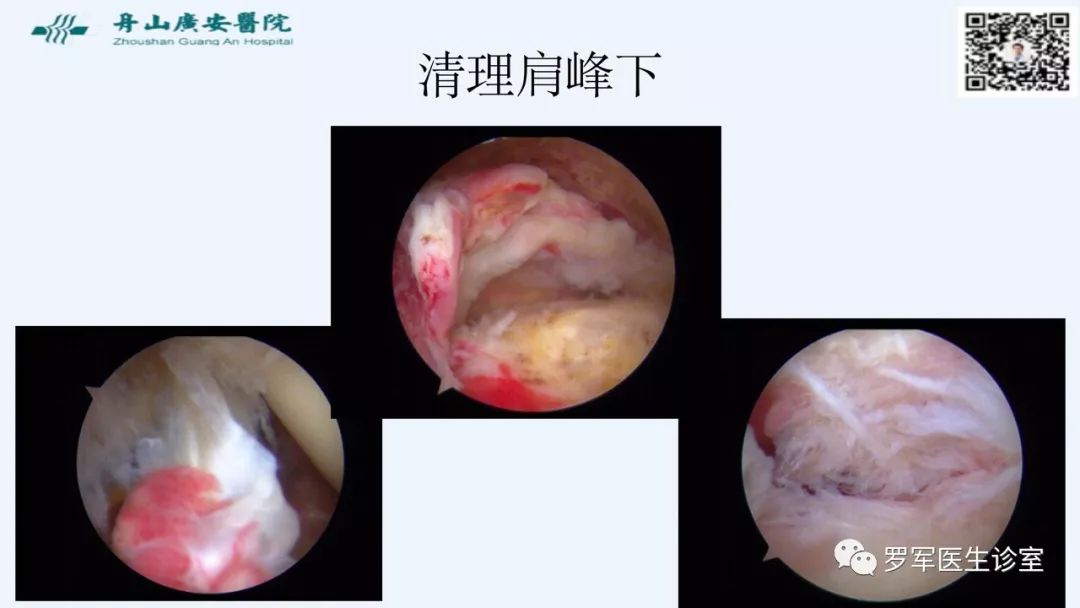 治疗肩袖撕裂，告诉你一种新的修补技术！