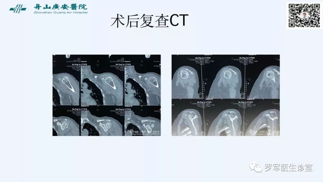 治疗肩袖撕裂，告诉你一种新的修补技术！