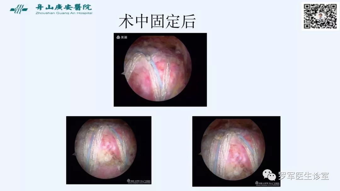 治疗肩袖撕裂，告诉你一种新的修补技术！