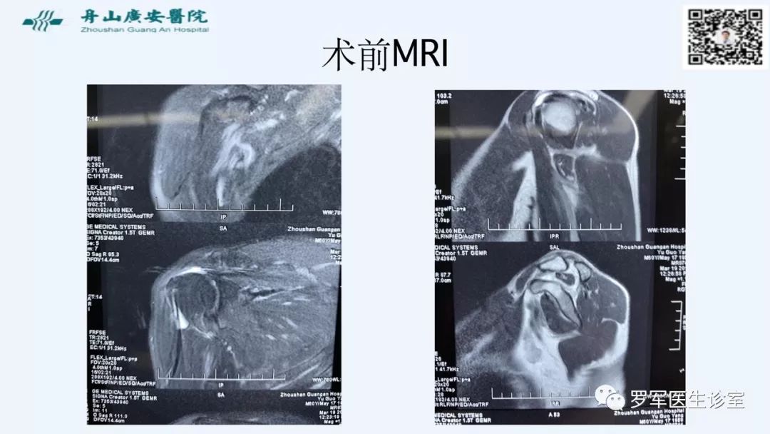 治疗肩袖撕裂，告诉你一种新的修补技术！