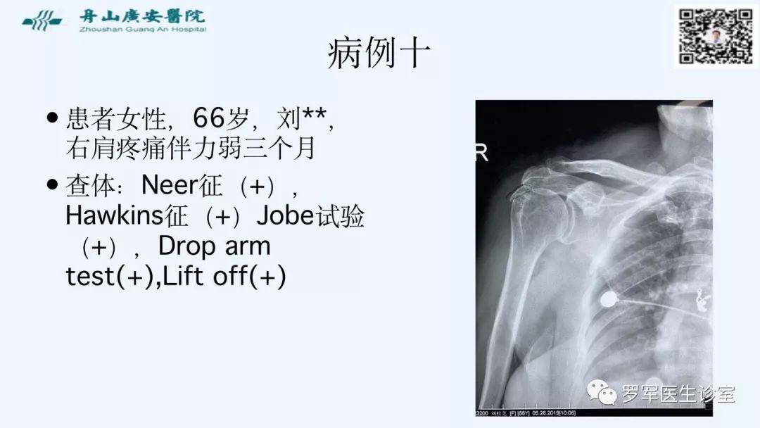 治疗肩袖撕裂，告诉你一种新的修补技术！