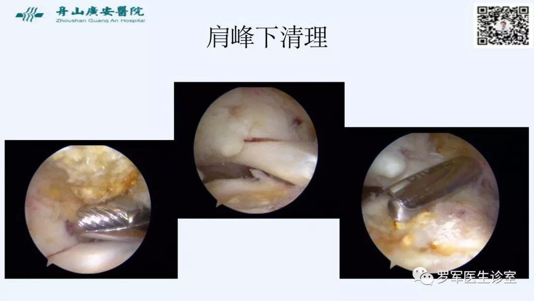 治疗肩袖撕裂，告诉你一种新的修补技术！