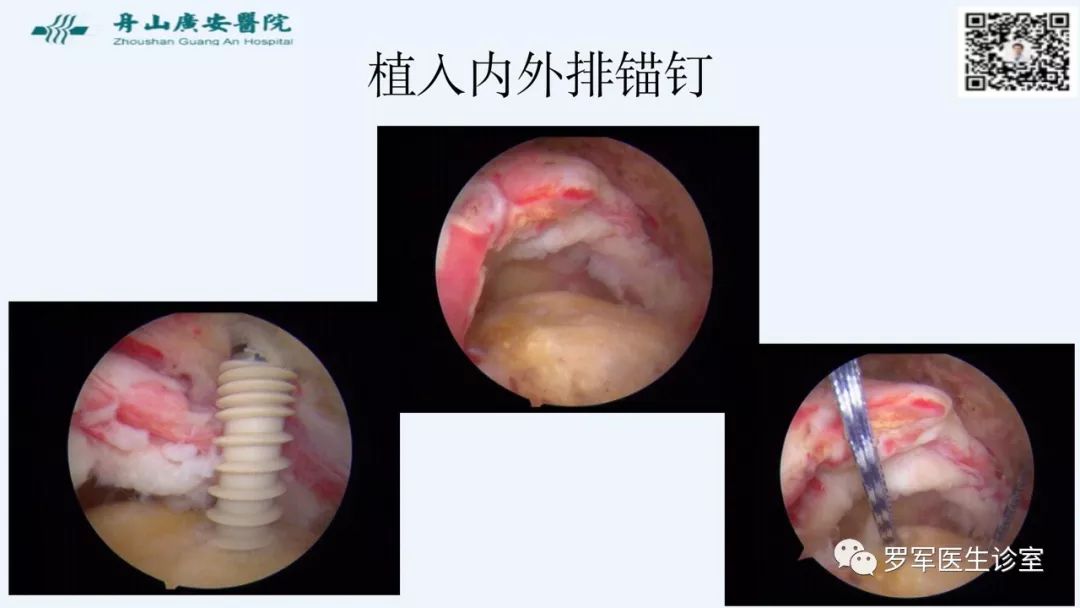 治疗肩袖撕裂，告诉你一种新的修补技术！