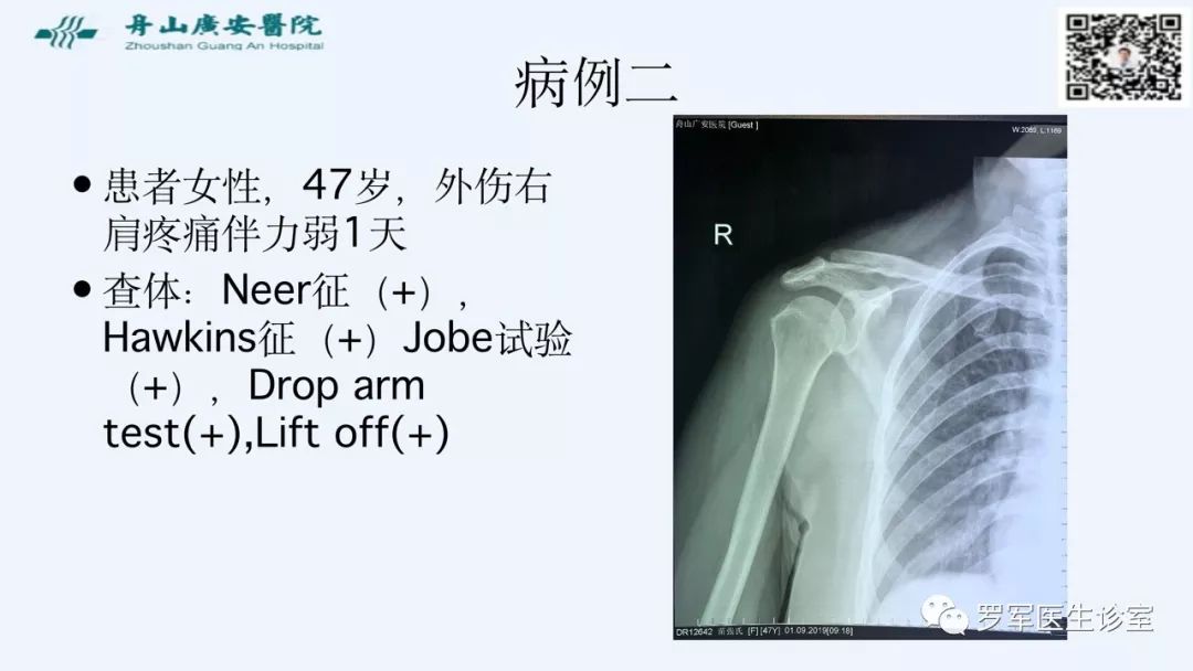 治疗肩袖撕裂，告诉你一种新的修补技术！