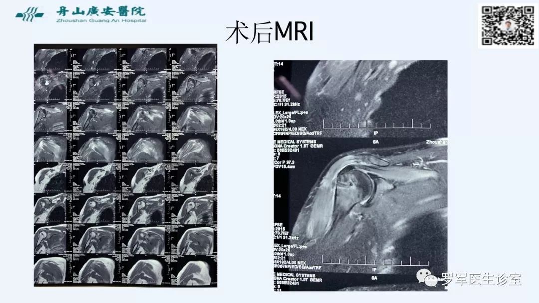 治疗肩袖撕裂，告诉你一种新的修补技术！