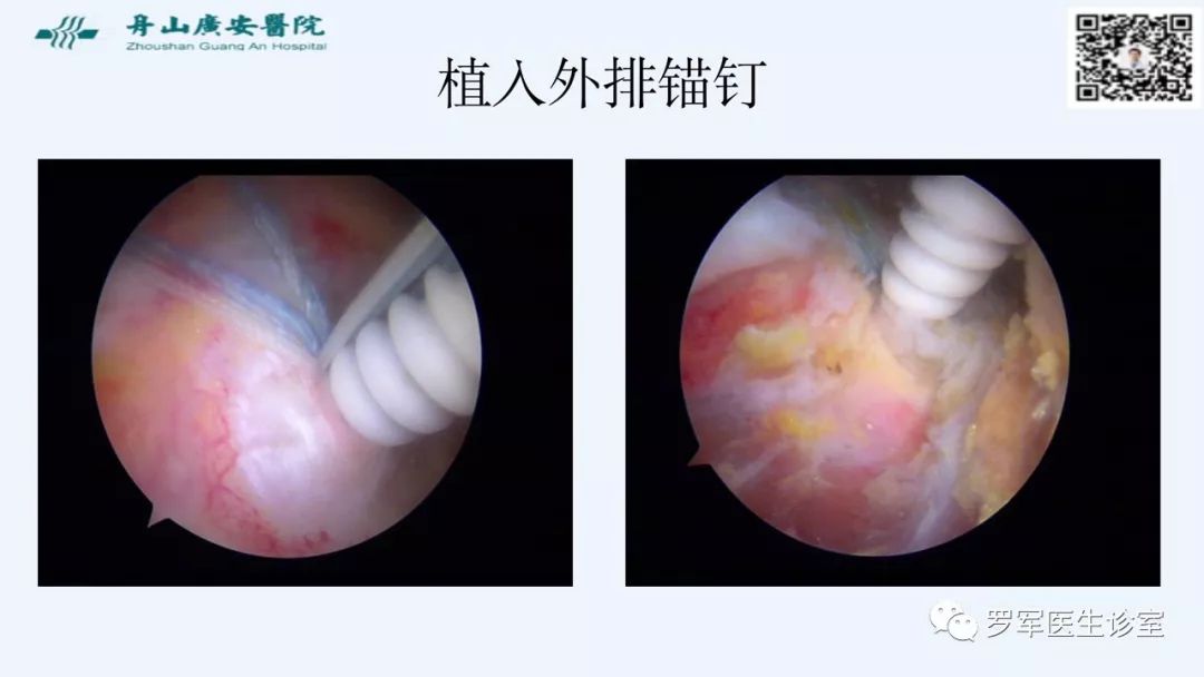 治疗肩袖撕裂，告诉你一种新的修补技术！