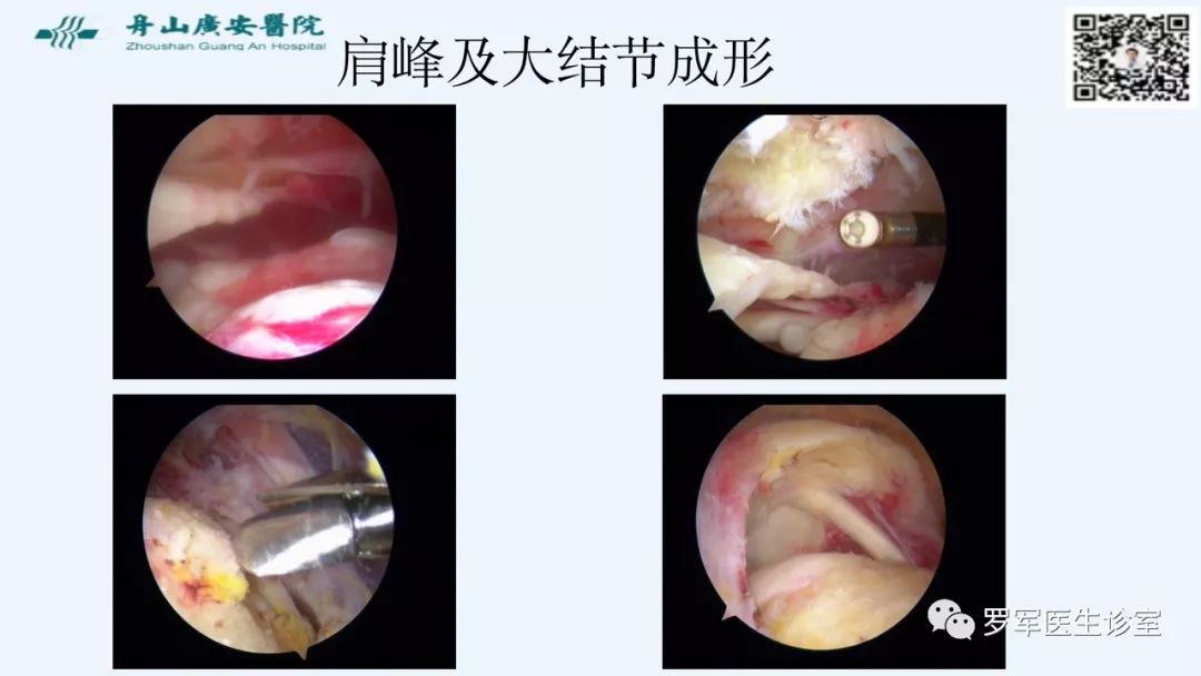 治疗肩袖撕裂，告诉你一种新的修补技术！