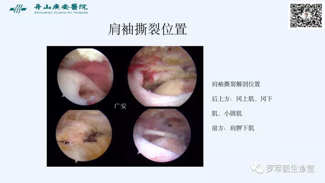 治疗肩袖撕裂，告诉你一种新的修补技术！