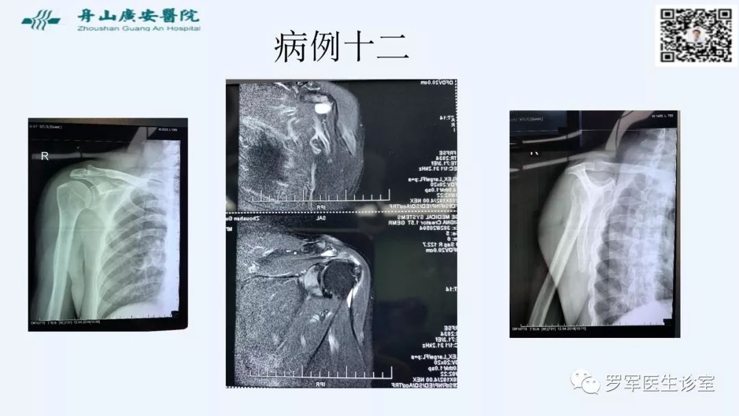 治疗肩袖撕裂，告诉你一种新的修补技术！