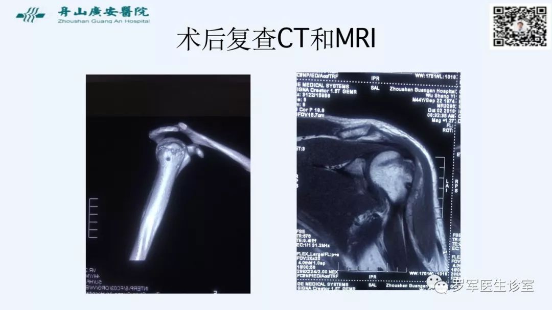 治疗肩袖撕裂，告诉你一种新的修补技术！