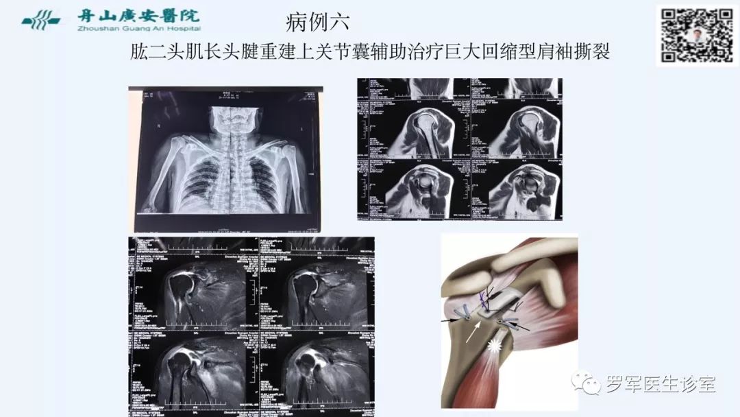 治疗肩袖撕裂，告诉你一种新的修补技术！