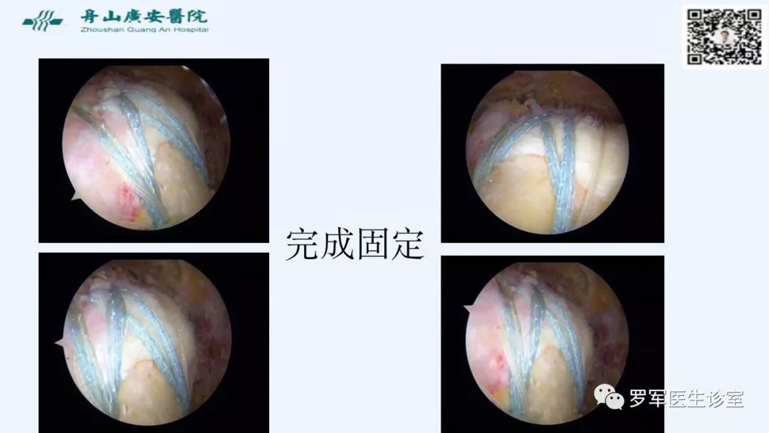 治疗肩袖撕裂，告诉你一种新的修补技术！