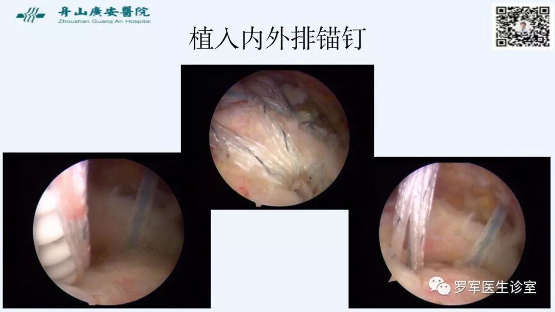 治疗肩袖撕裂，告诉你一种新的修补技术！