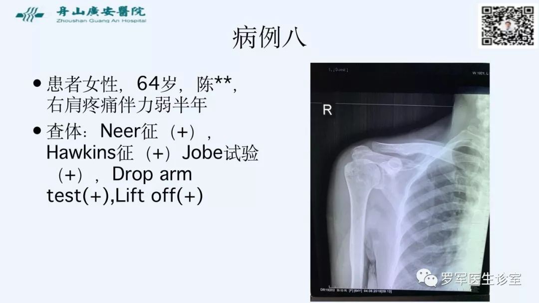 治疗肩袖撕裂，告诉你一种新的修补技术！