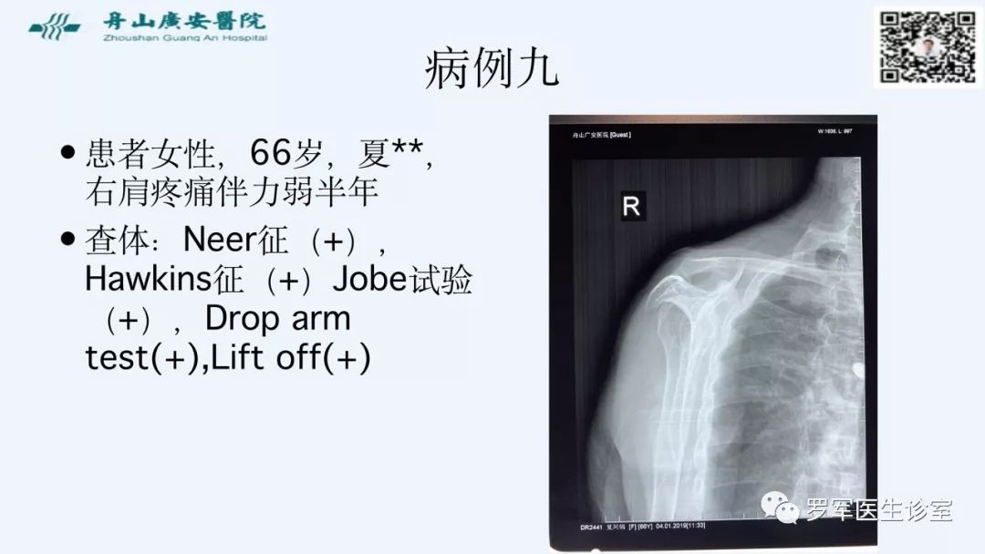 治疗肩袖撕裂，告诉你一种新的修补技术！