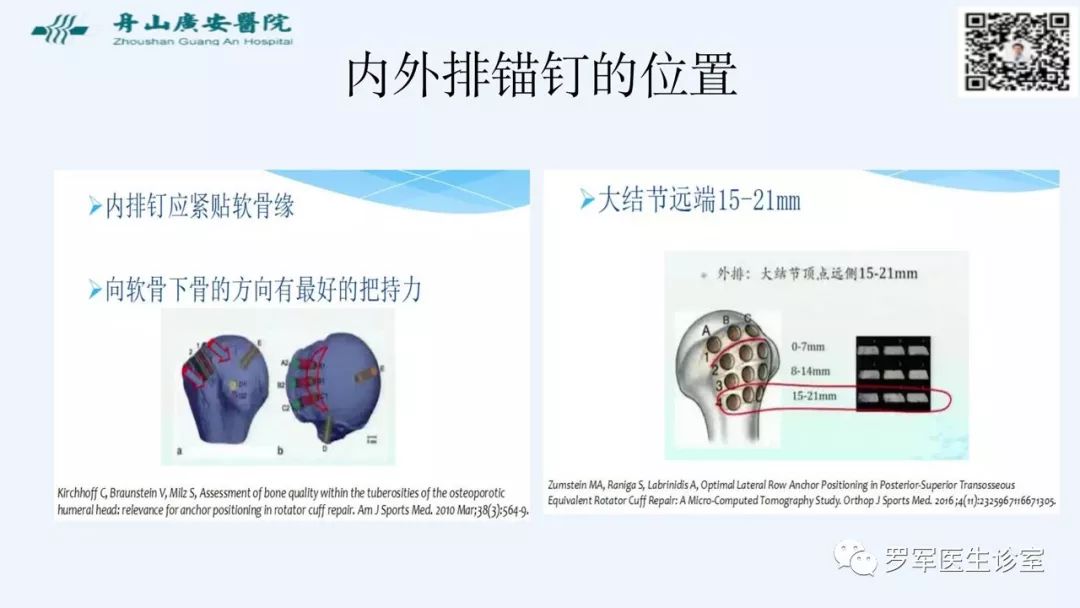 治疗肩袖撕裂，告诉你一种新的修补技术！