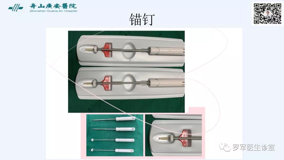 治疗肩袖撕裂，告诉你一种新的修补技术！