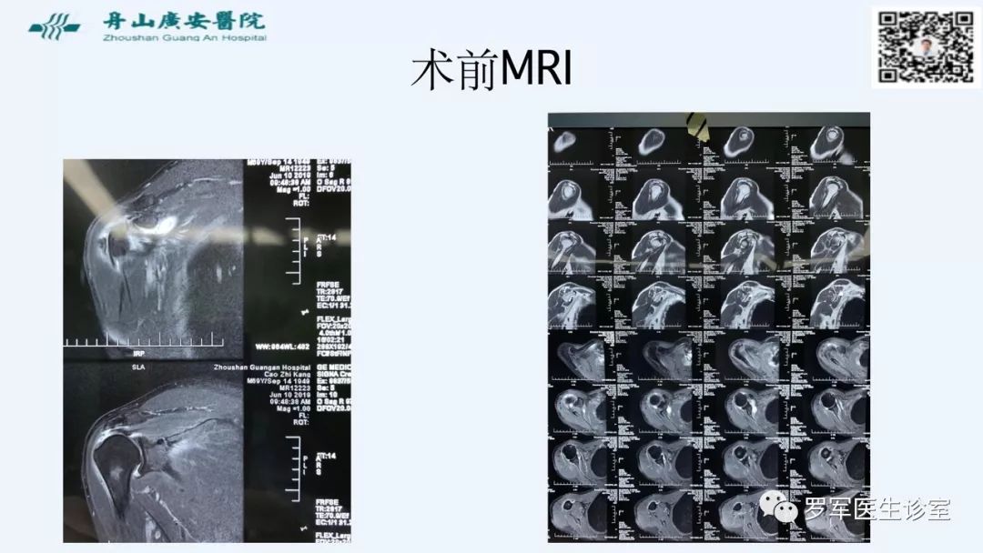 治疗肩袖撕裂，告诉你一种新的修补技术！