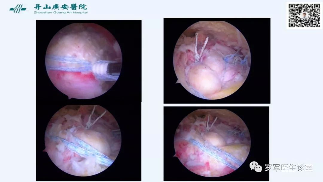 治疗肩袖撕裂，告诉你一种新的修补技术！