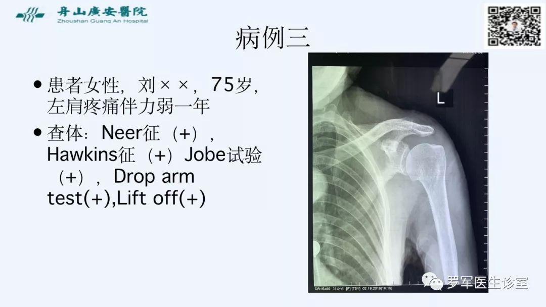 治疗肩袖撕裂，告诉你一种新的修补技术！