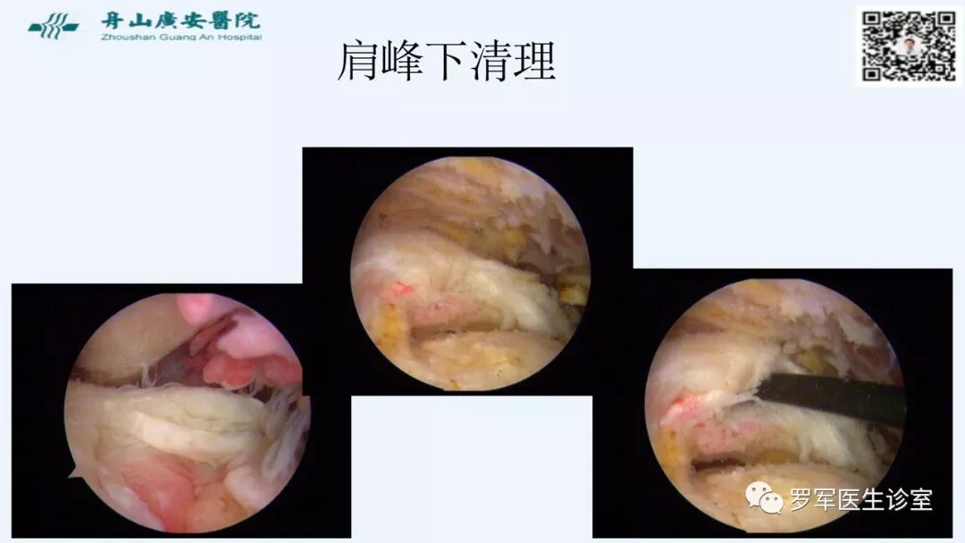 治疗肩袖撕裂，告诉你一种新的修补技术！