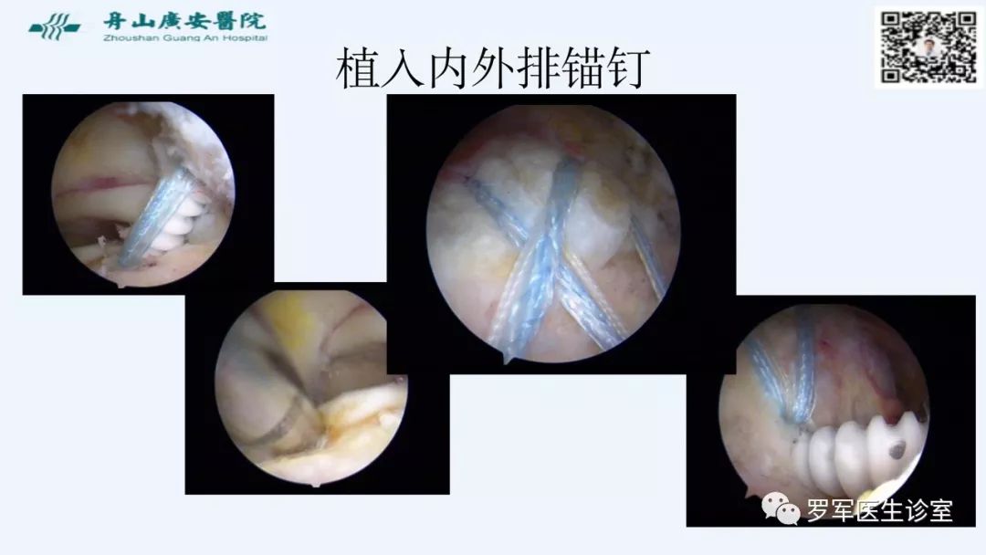 治疗肩袖撕裂，告诉你一种新的修补技术！