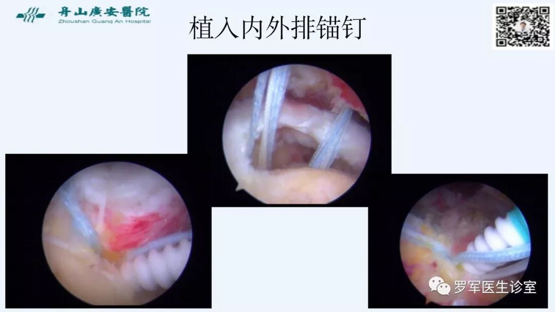 治疗肩袖撕裂，告诉你一种新的修补技术！