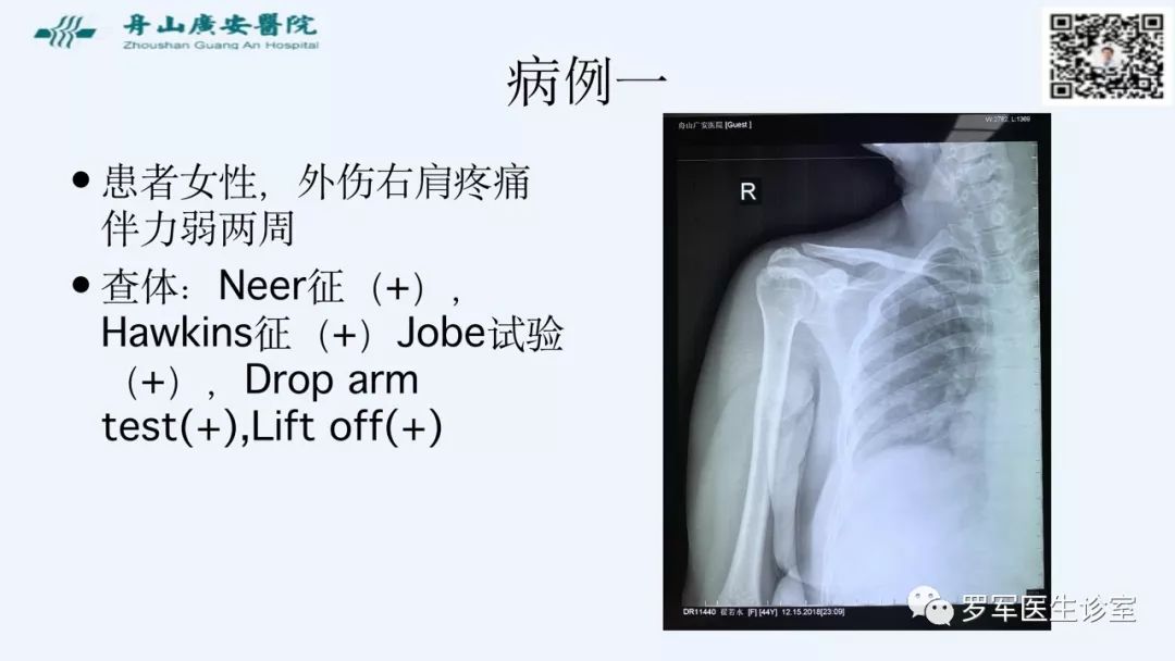 治疗肩袖撕裂，告诉你一种新的修补技术！